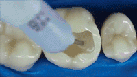 牙齿根管治疗步骤动图图片