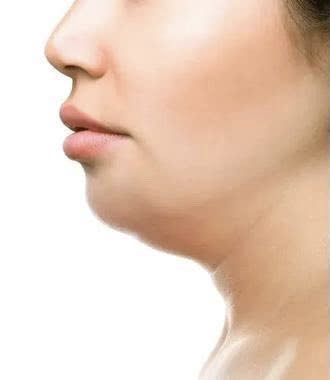 什么人适合做下颌缘和双下巴吸脂