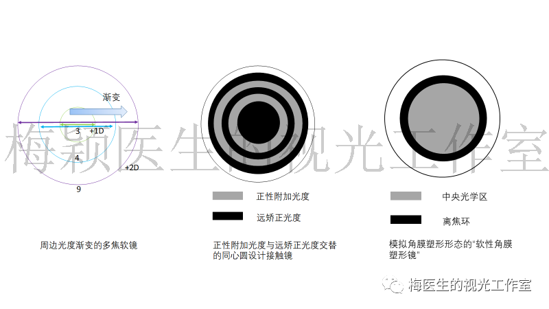 图1 不同设计的多焦点软镜示意图 二,多焦软镜的近视控制作用 已有