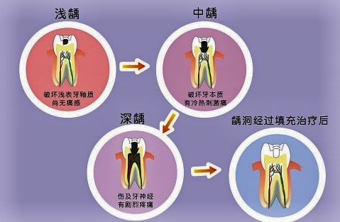 儿童发生在牙颈部的龋齿极少,只在严重营养不良或某些全身性疾病使