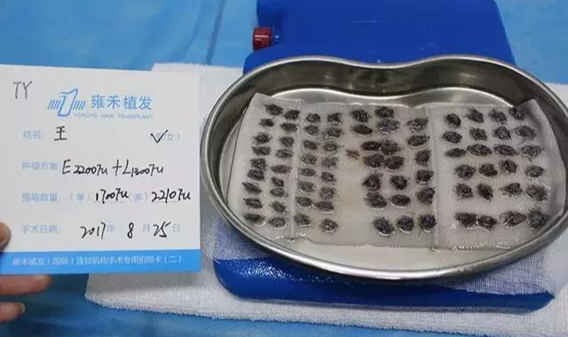 手术中分离的毛囊