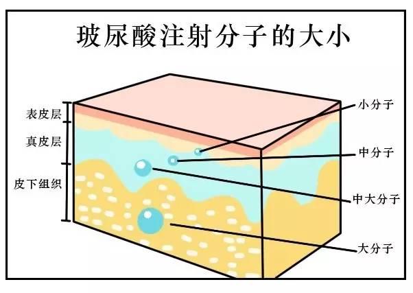 一管Elvi玻尿酸多少钱？三种适合填充的部位一样吗？持续时间一样吗？玻尿酸钱一针多少毫升