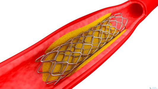 国产和进口心脏支架有何区别?