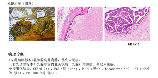 左侧乳腺癌我们推测跟左侧导管内乳头状瘤癌变有关.