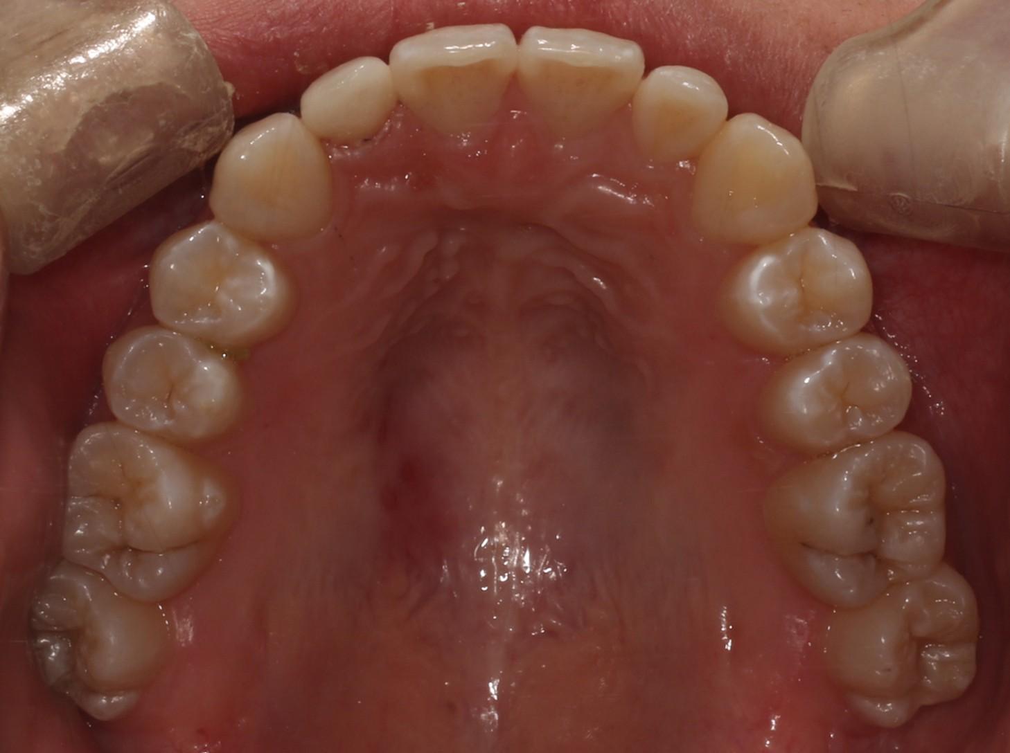 牙齿拥挤后牙反颌矫治过程