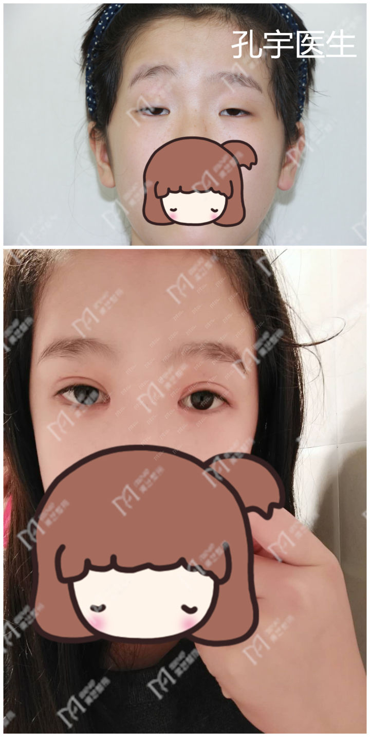 小睑裂综合征一旦确诊需要及时有效的治疗