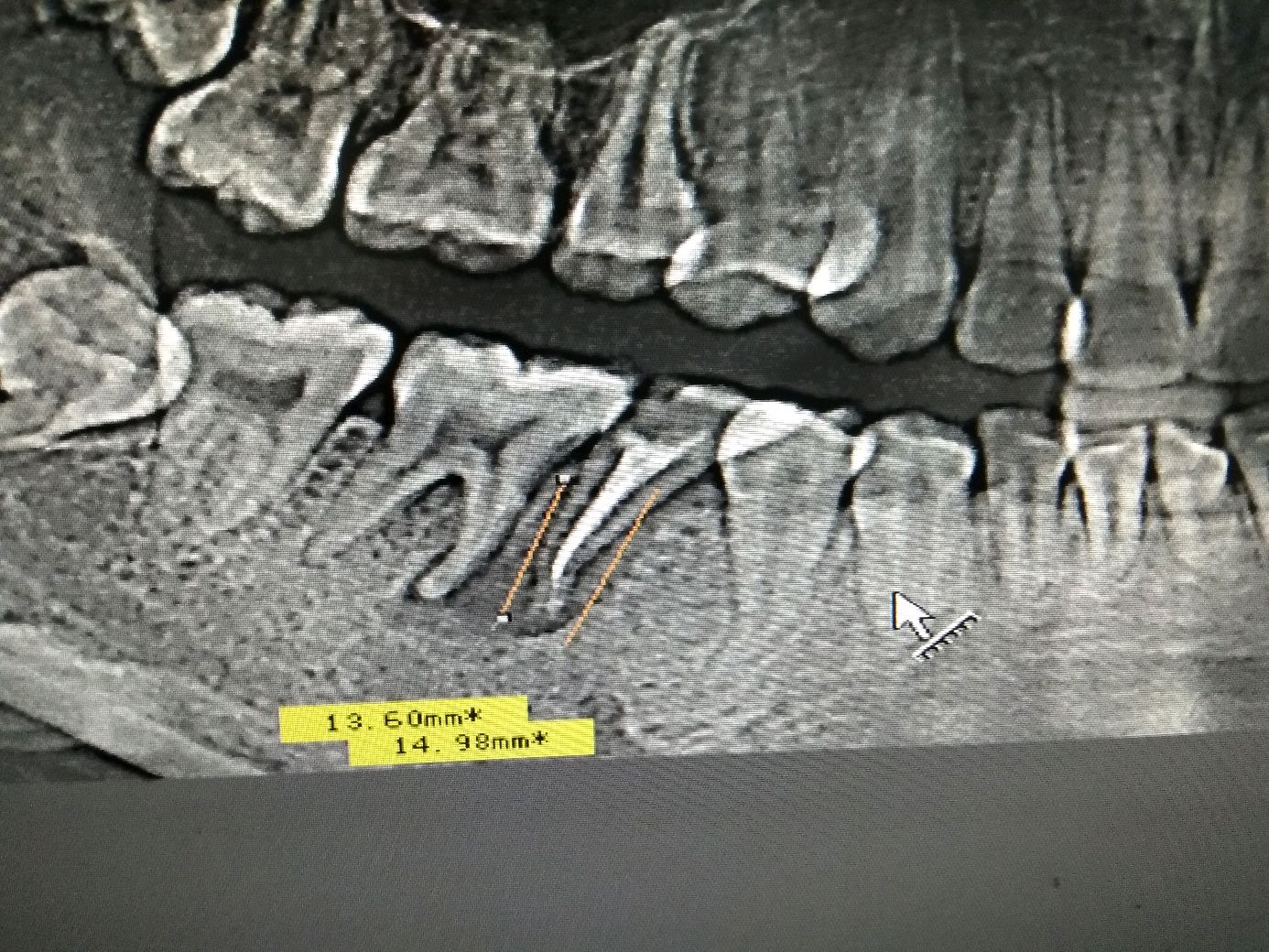附x片，右下最后一颗大牙已拔，牙槽骨吸收或缺损严重吗？这样情况能做种植呀吗？怎么做？需要植骨？_百度知道