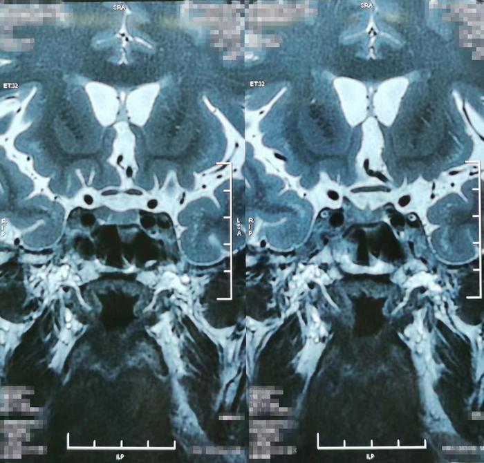 这种莫名的突然长胖要警惕,可能与垂体瘤有关!
