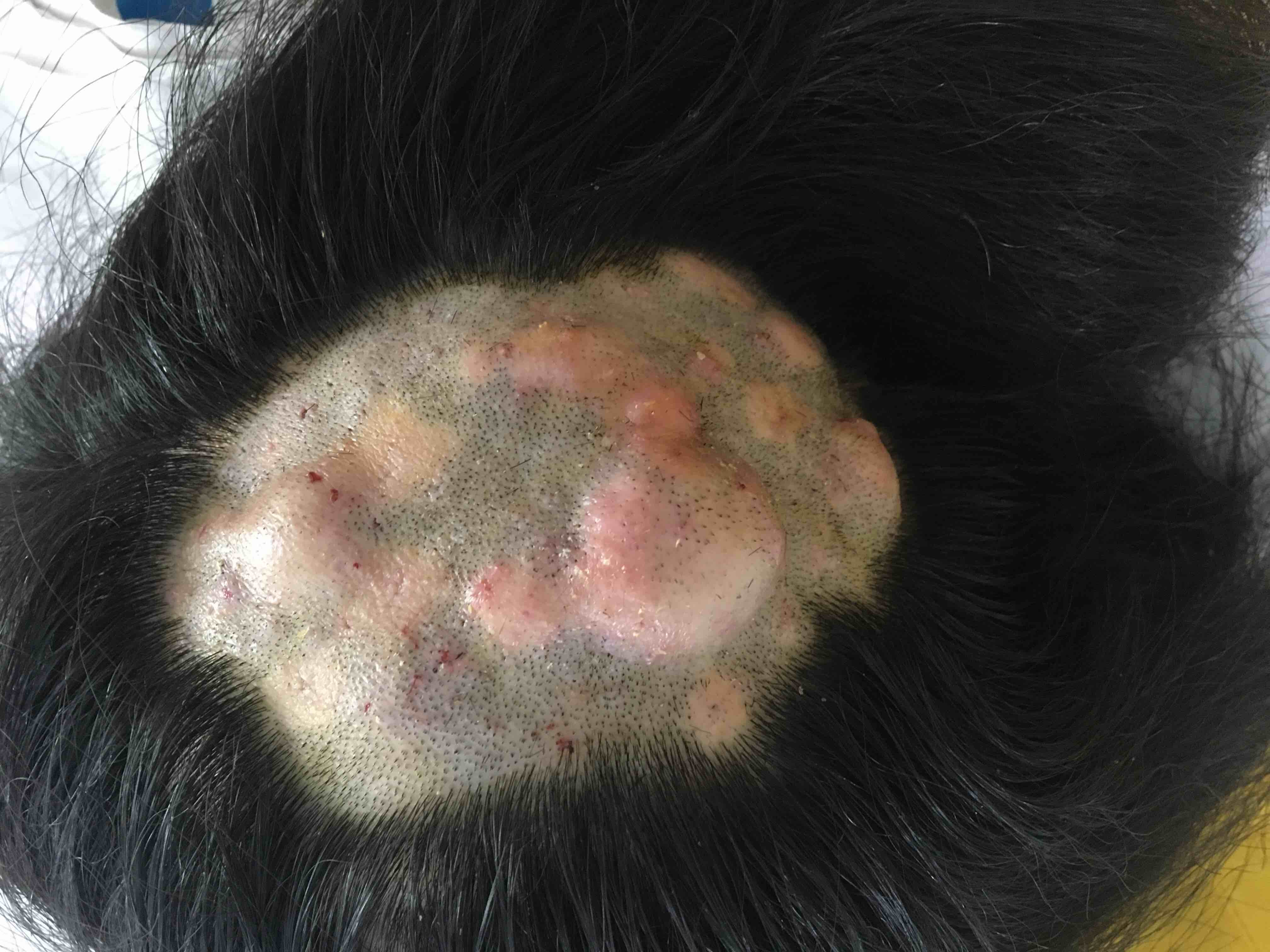 头皮下脂肪瘤图片
