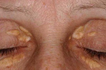 睑黄瘤是由于脂质沉积于眼睑部位而引起的,多发生在眼睑上,初起如米粒