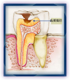 齒質(牙本質)是位於牙釉質下面較為柔軟的一層物質.