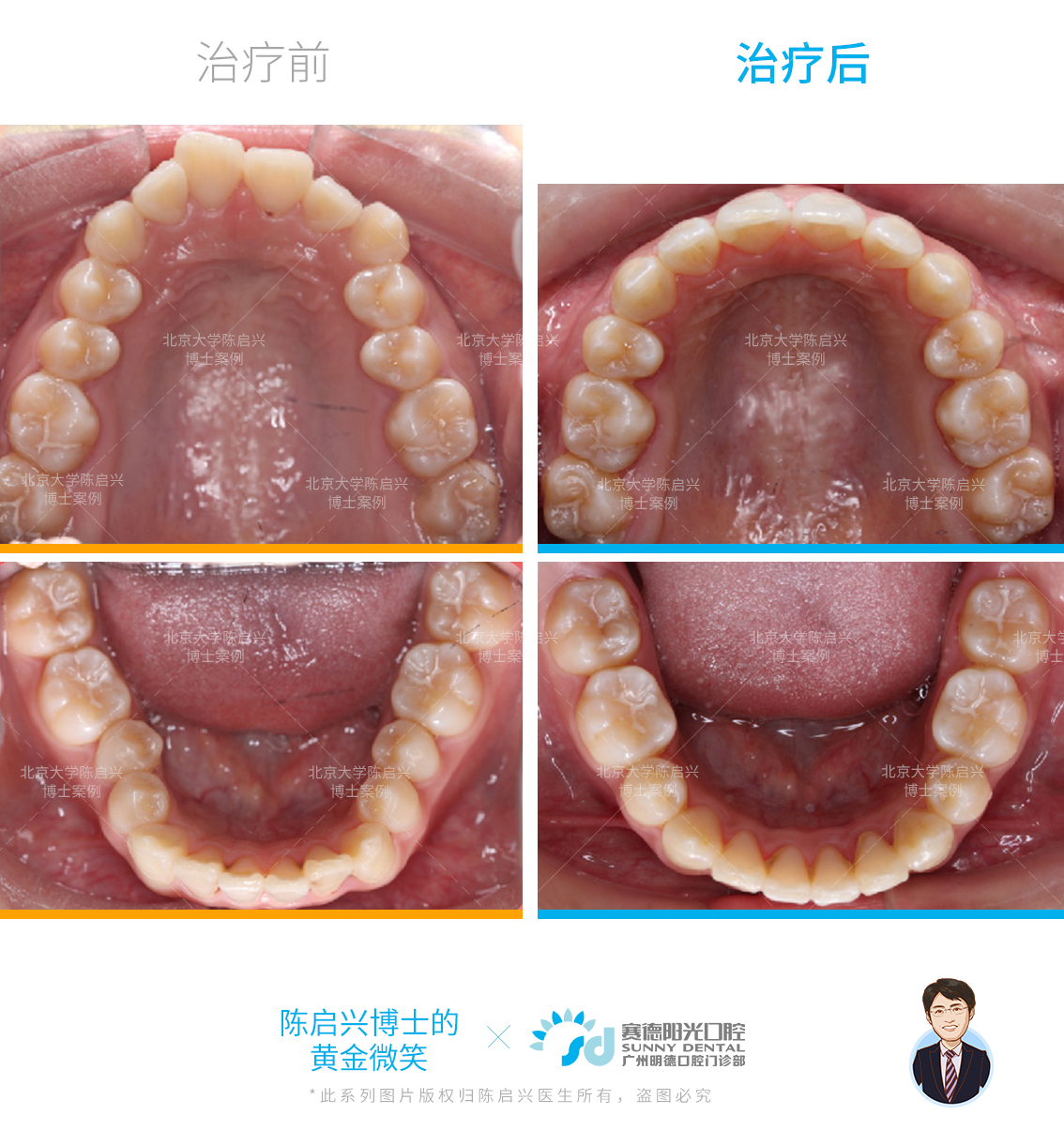 深覆合侧脸对比图片