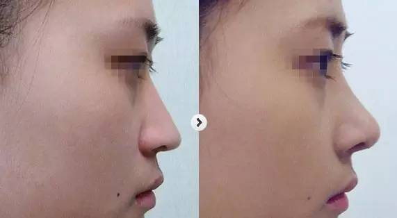 为什么有些人做完鼻综合反而显得更成熟