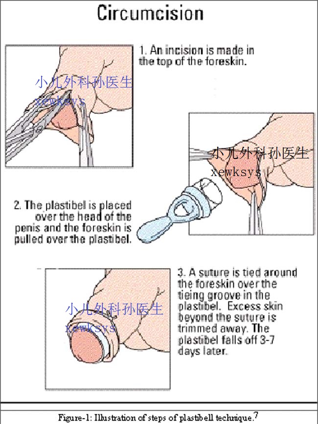 环切手术步骤图图片