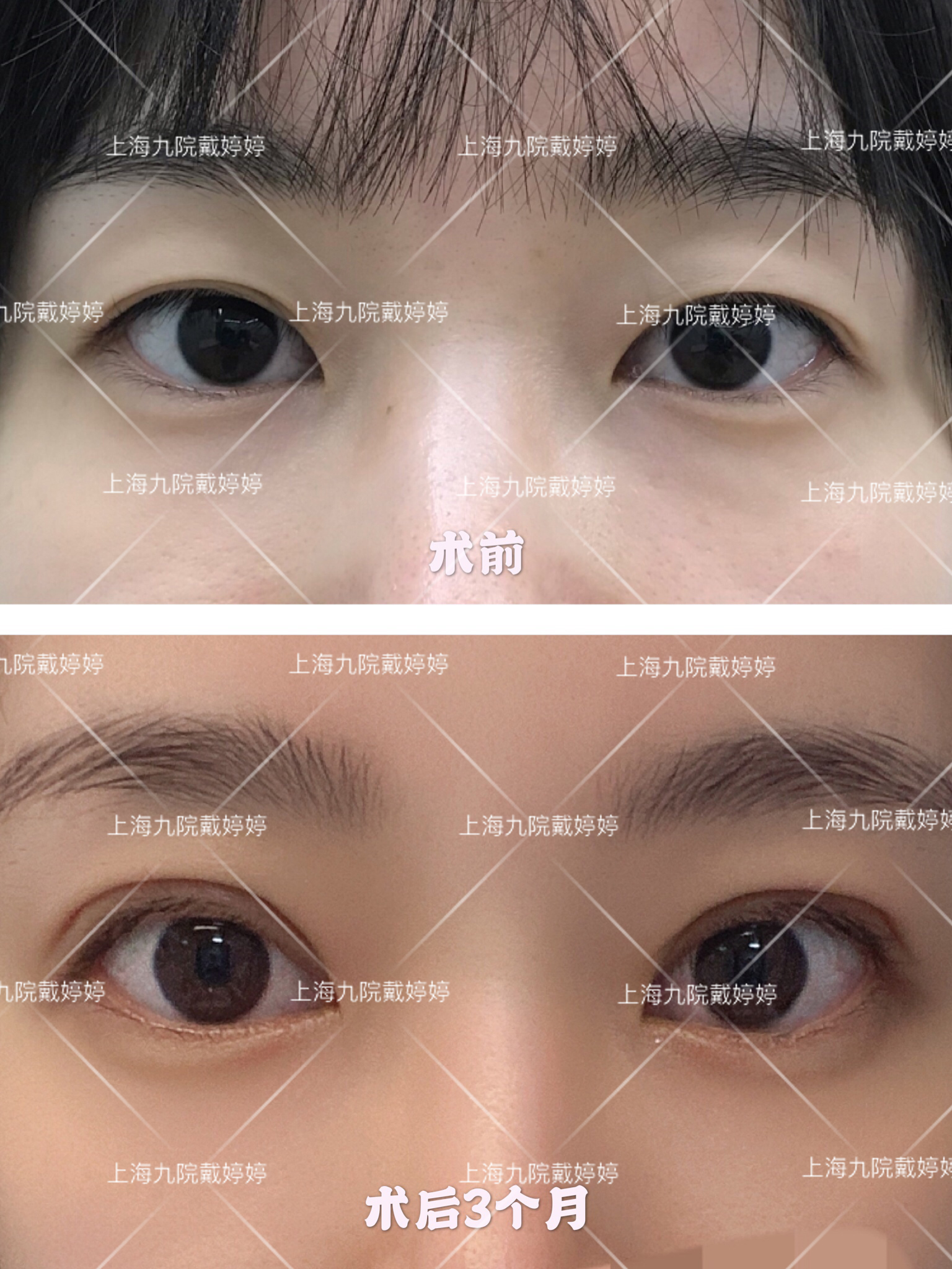 汝之明眸我来打造关于眼整形的那些术式