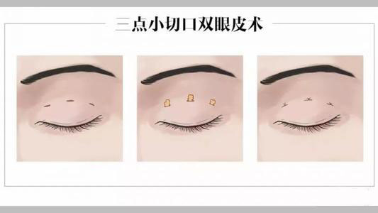 三点定位双眼皮.jpg
