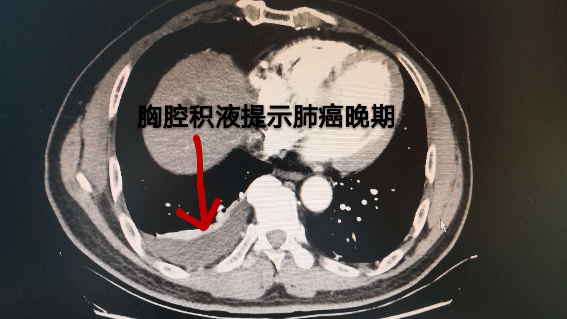 肺癌胸腔积液图片