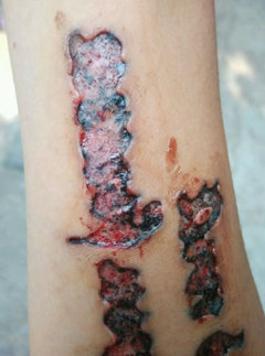 第三种烧灼法祛纹身,也就是用烧红的烙铁甚至烟头将纹身连同皮肤一起