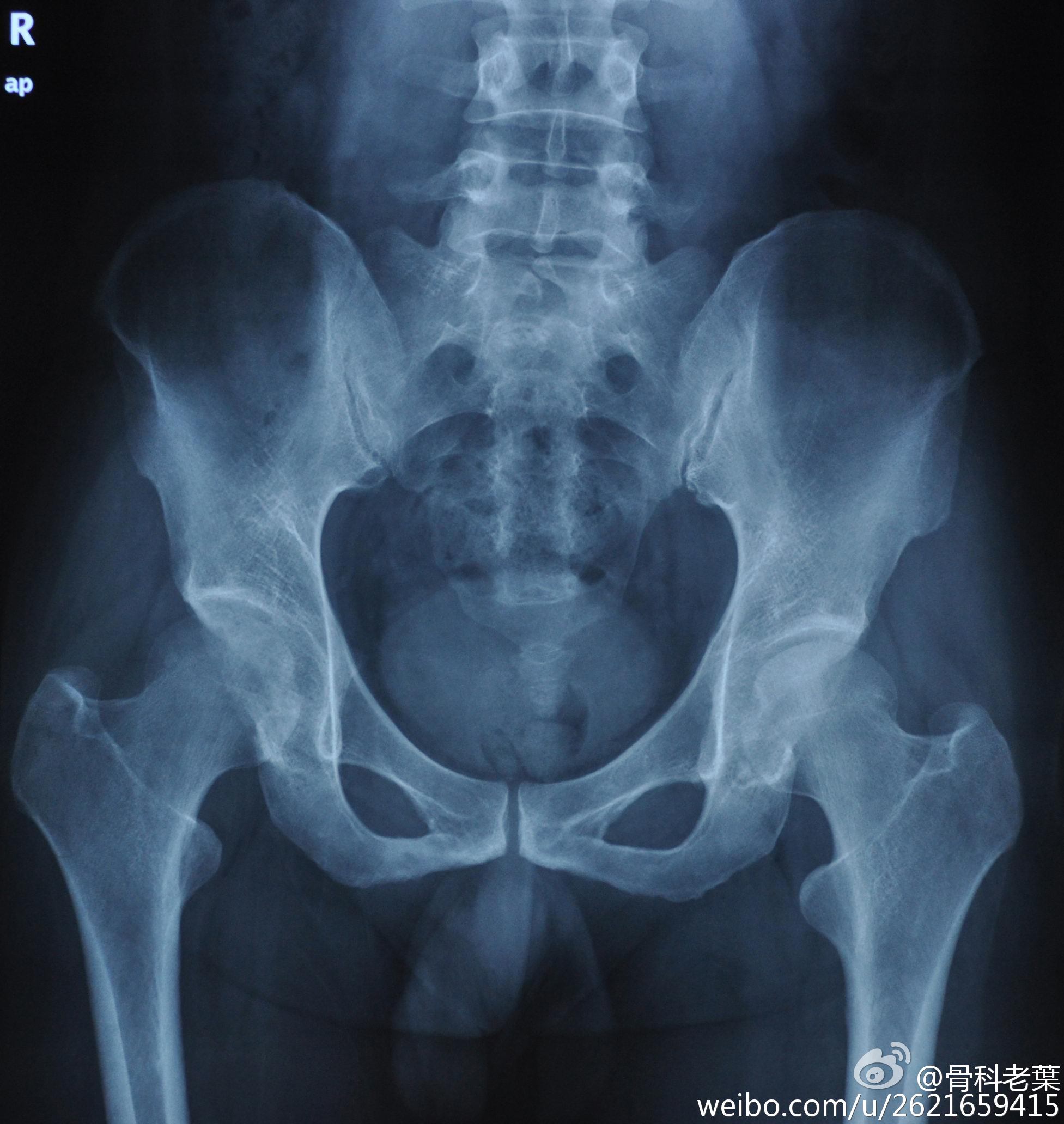 股骨头坏死是不死的癌症吗?绝对不是.