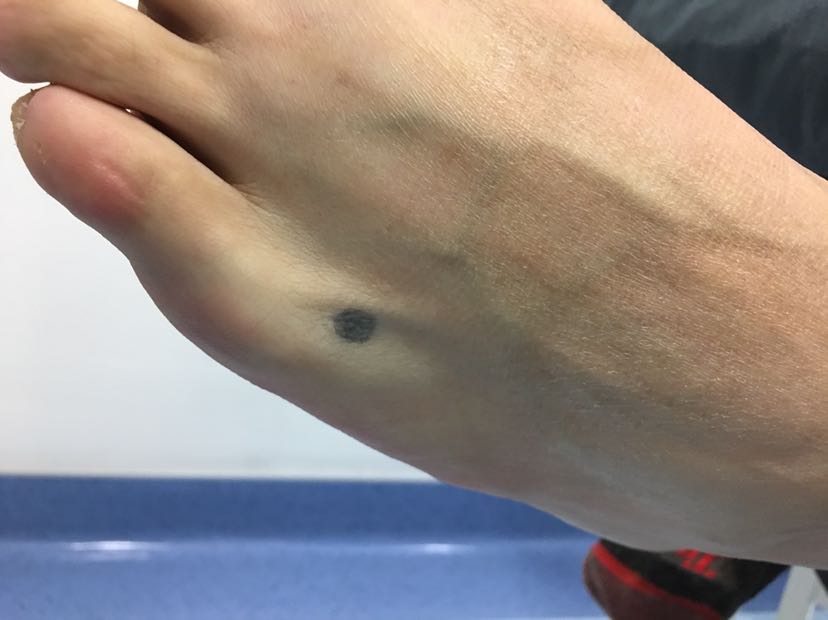 足背这么大痦子需要做手术切除吗