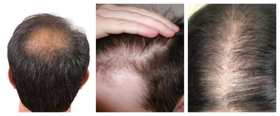 遗传性秃顶现在能治好么?会遗传给下一代?(附遗传性脱发改善)