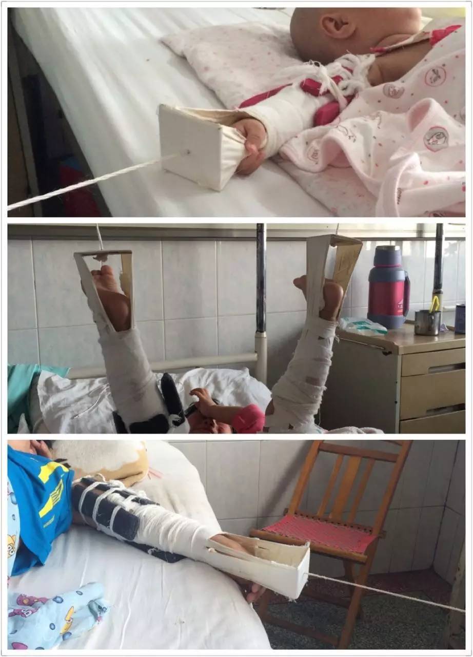 不同治疗方法也不同,多是采用手法闭合复位夹板(或石膏)外固定的方法