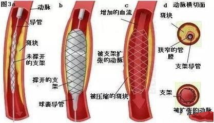 心脏血管支架为何要上万元? 心脏血管支架是什么做的?