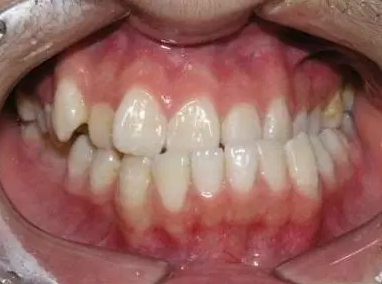 常用一侧牙齿吃饭的你变丑了吗