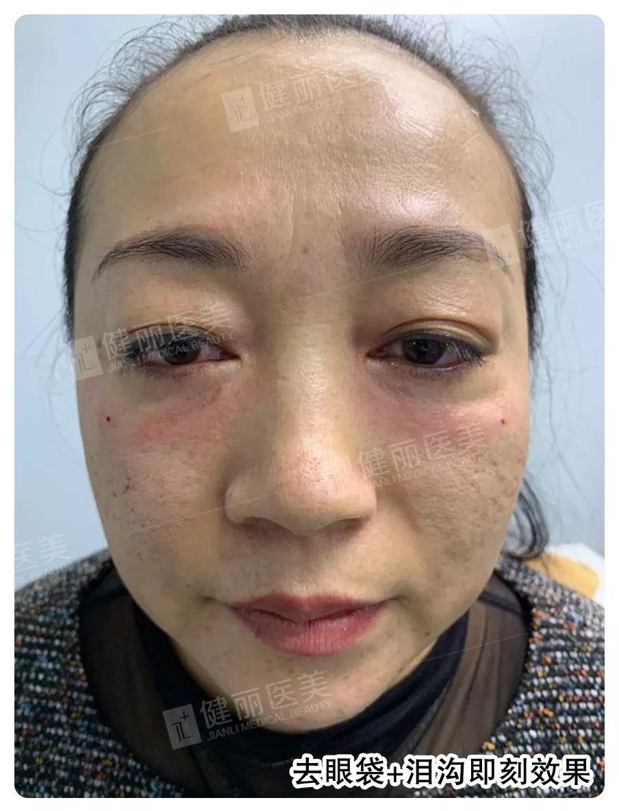 眼部状态必须给100分自从去掉这10年的眼袋和泪沟后珍姐变得精神饱满