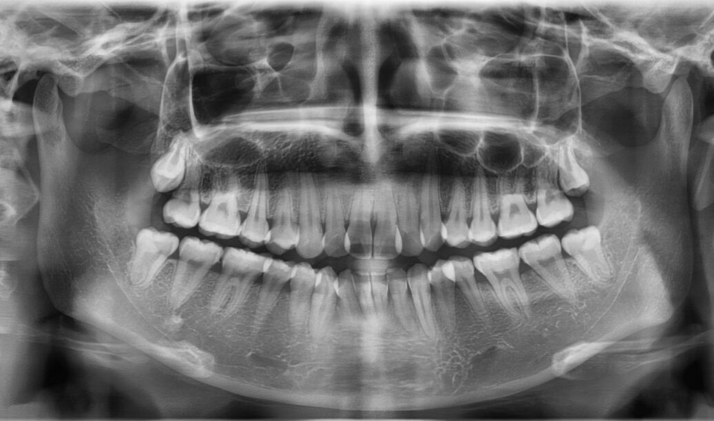 我院医师进行牙齿矫正的牙片分享