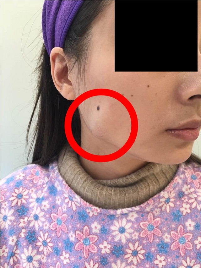 怎样减掉面部和颈部的肉