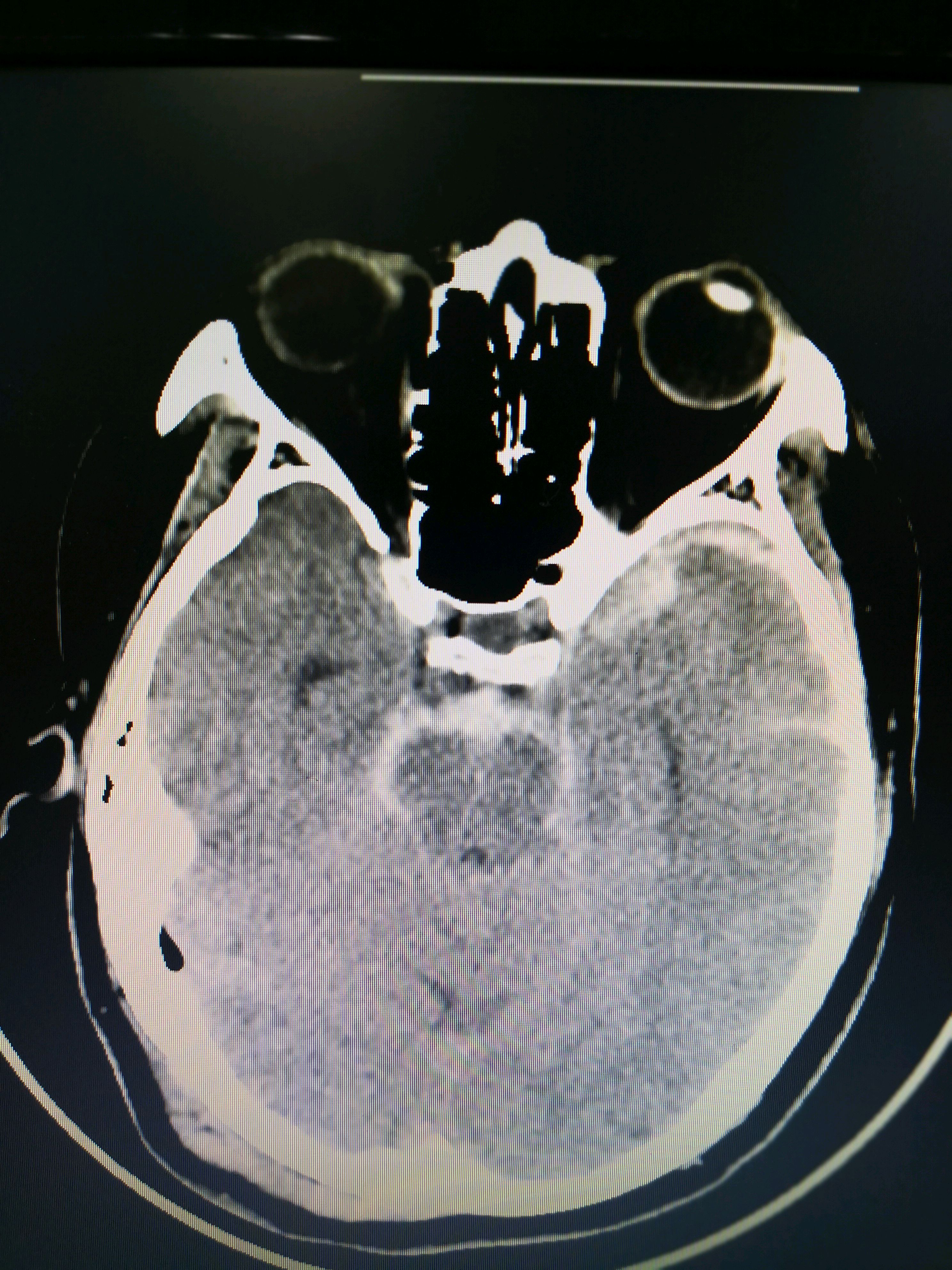 蛛网膜下腔出血脑ct图图片