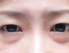 衰老型眼袋(眼轮匝肌及睑隔严重松弛,睑隔脂肪下垂)先天性眼袋是由