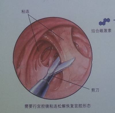人流后有种痛你只有后悔