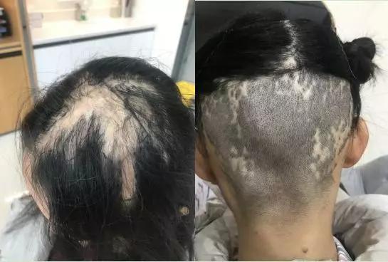 小时候的烫伤成为爱美的一道坎