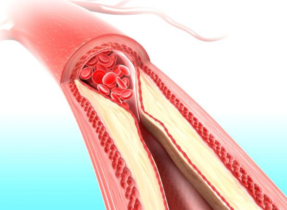 血管是如何硬化狭窄的