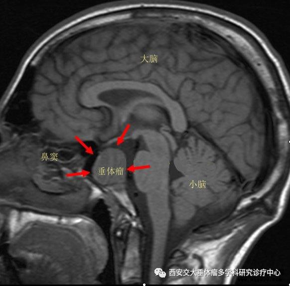其实发生"蝶鞍区"的疾病在我们医学上专业叫作"鞍区占位",虽然鞍区