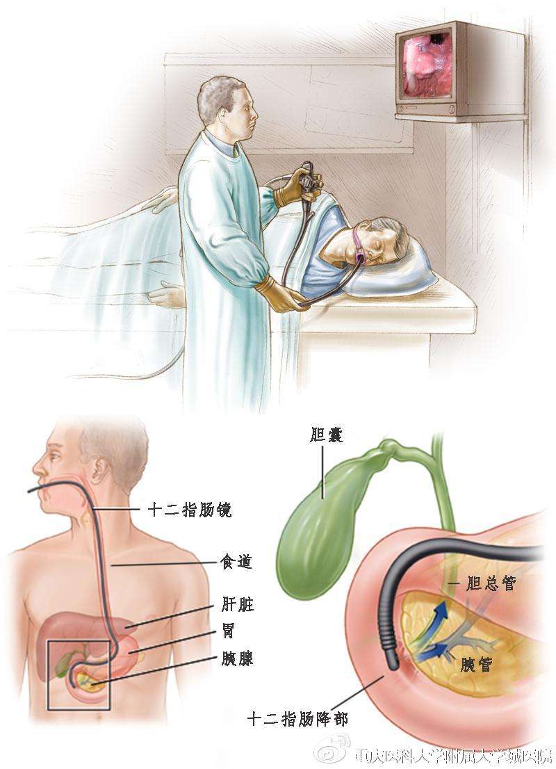 ercp不仅仅是检查竟然还能做这么多治疗