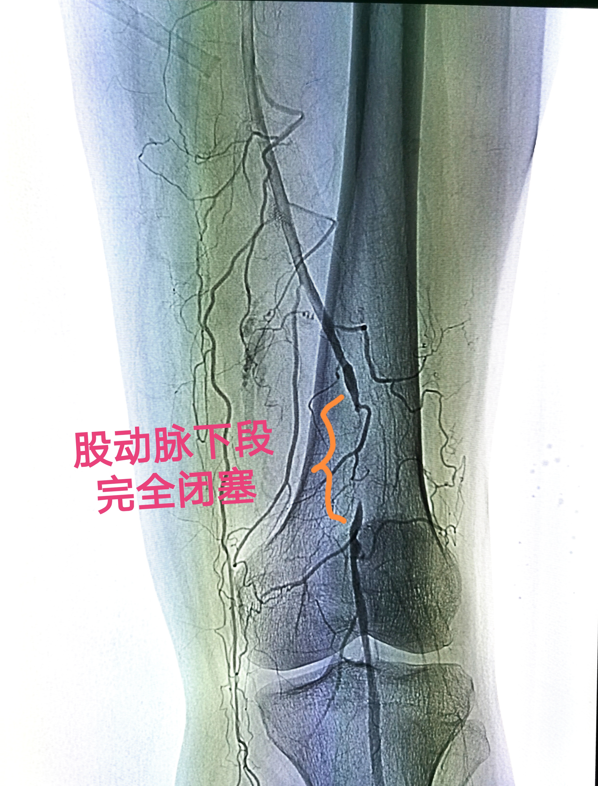 下肢動脈閉塞症及早治療的重要性