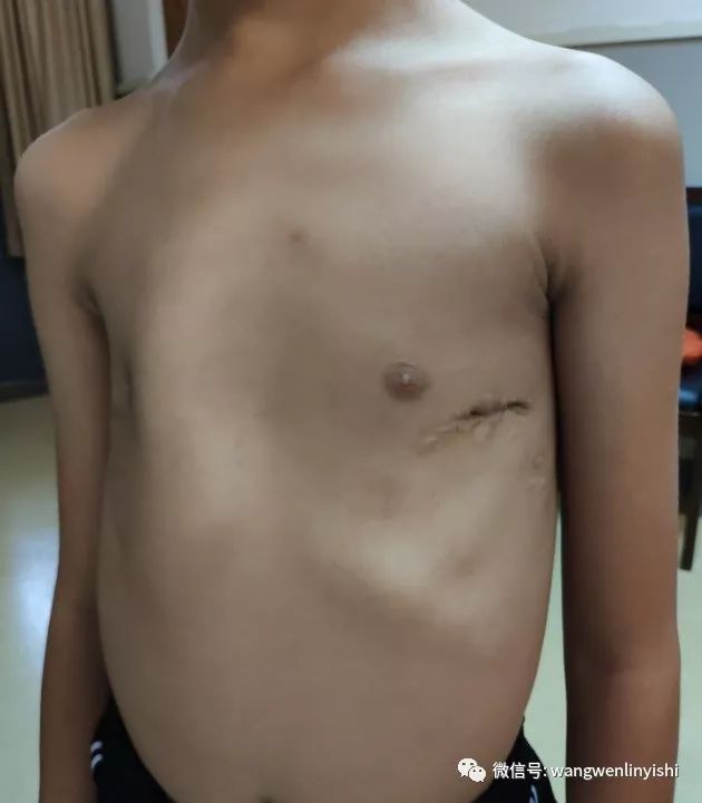 wenlin胸(鸽子胸),鸡胸,与漏斗胸-王文林主任医师-爱问医生