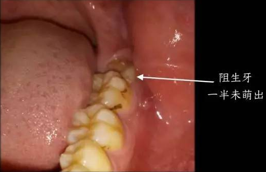 医生,我的智齿要不要拔?