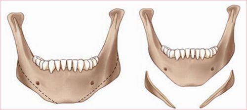 下颌角手术常见问题解答