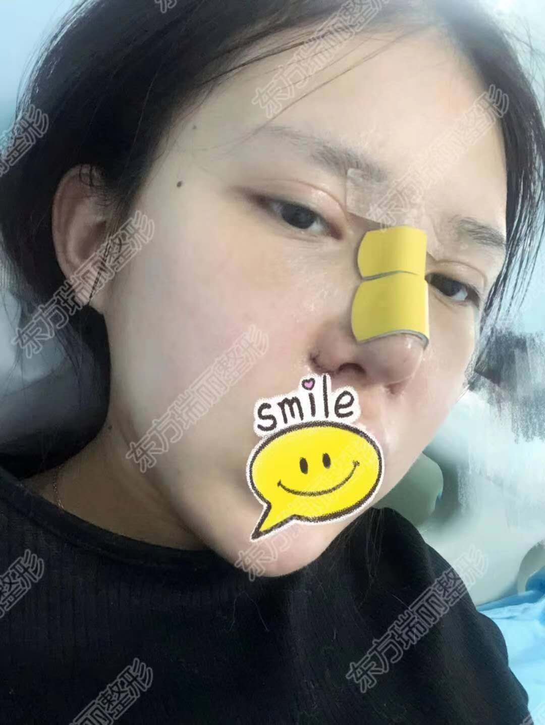 你不知道的异体骨隆鼻内附案例