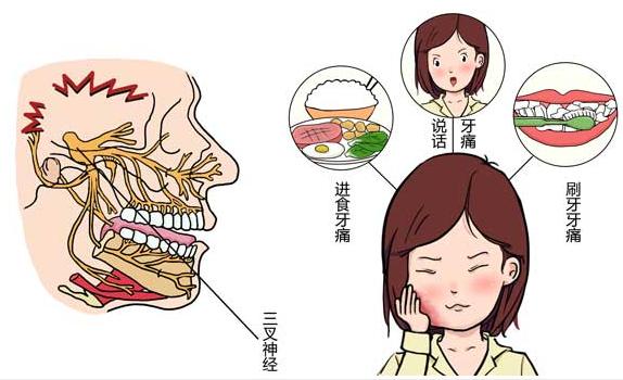 三叉神经痛患者显微血管减压手术效果及术后护理注意的问题