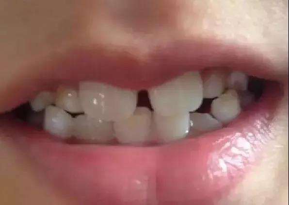 孩子的新牙长出来是“锯齿”,这是正常的吗?