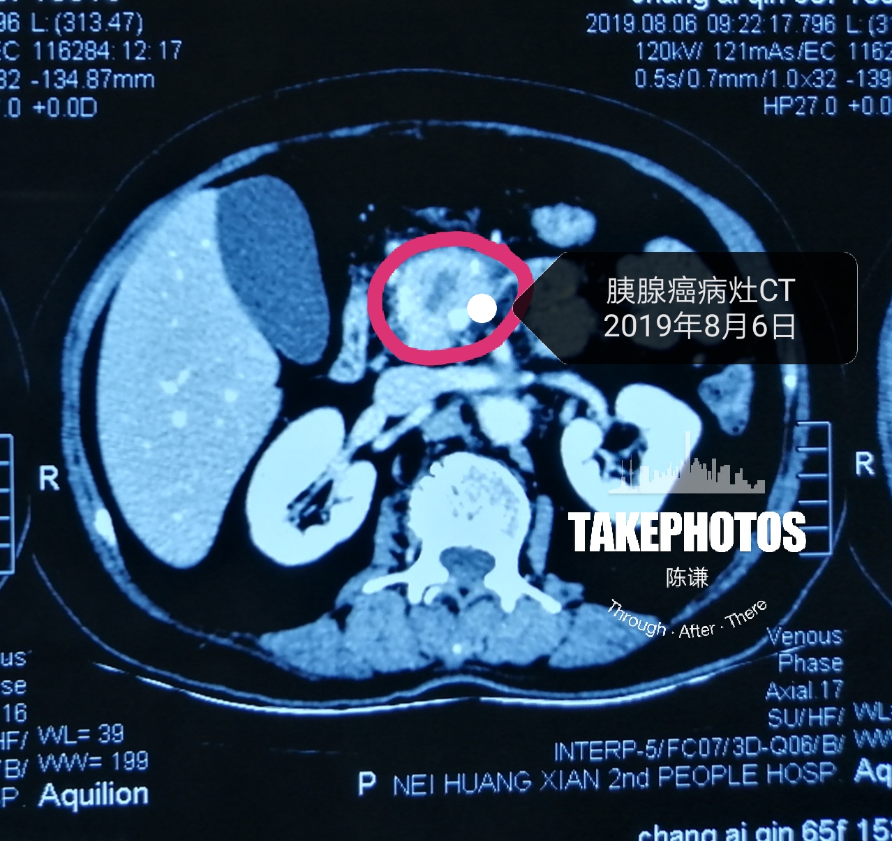 海扶高強度聚焦超聲消融手術治療胰腺癌病例分析