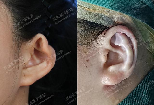 孩子出现隐耳怎么办还可以矫正吗