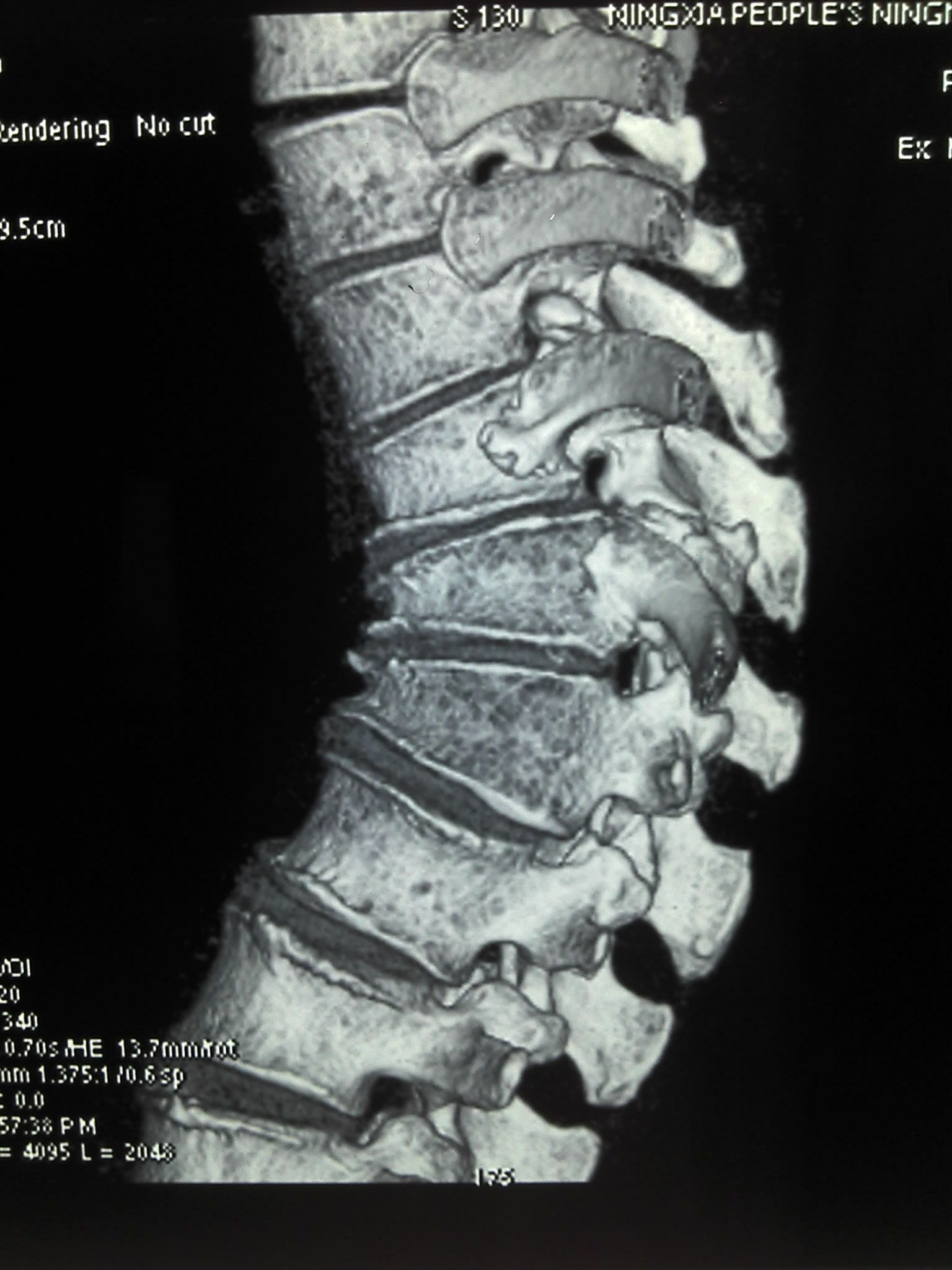 l1腰椎压缩性骨折图图片