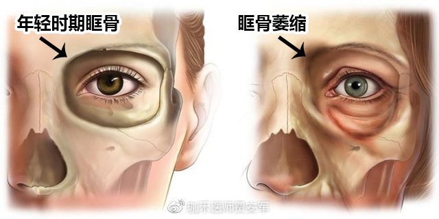 但随着人体衰老 眶骨有一部分会被吸收,眼眶的组织和皮肤没有了骨质