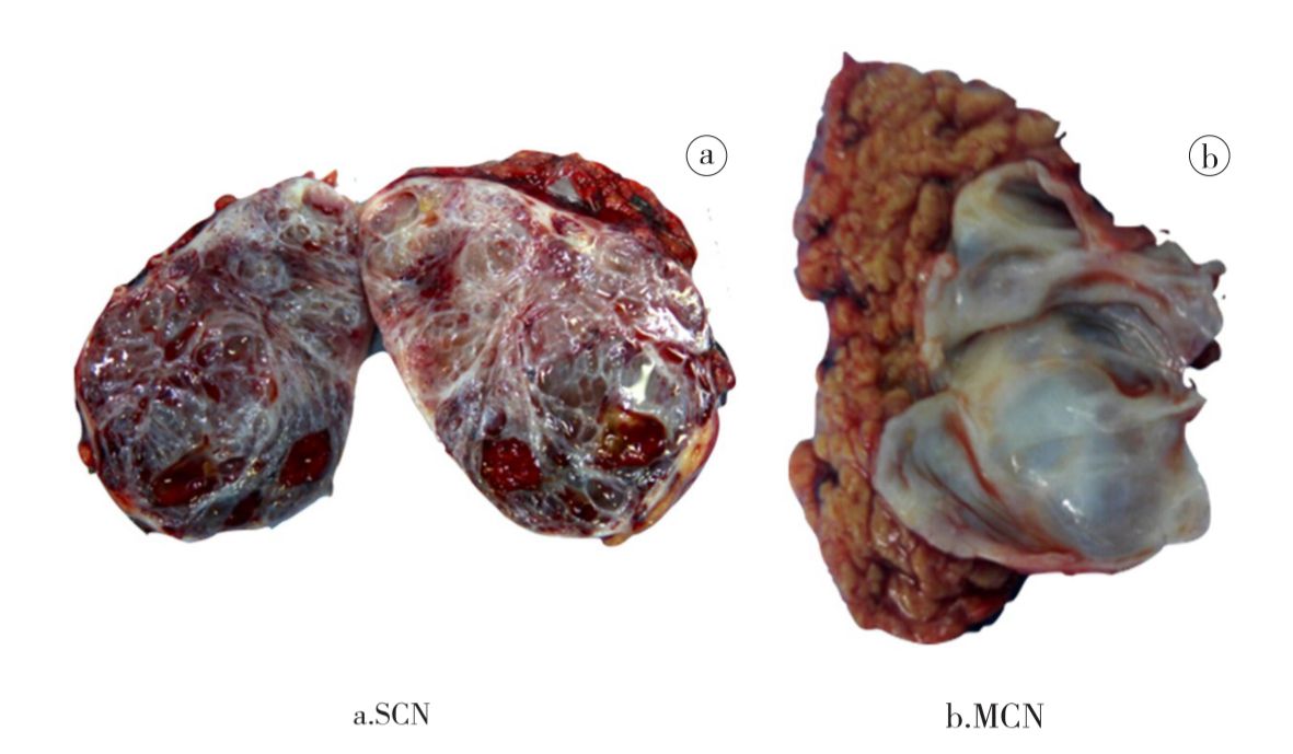 胰腺囊性肿瘤胰腺囊腺瘤